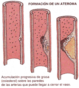 Formación de una placa de ateroma en una arteria