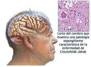 Enfermedad de Creutfeldt-Jacob